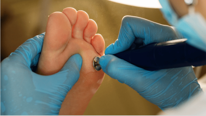 Tratamiento papiloma Valencia mediante terapia láser en clínica de podología La Zaidía